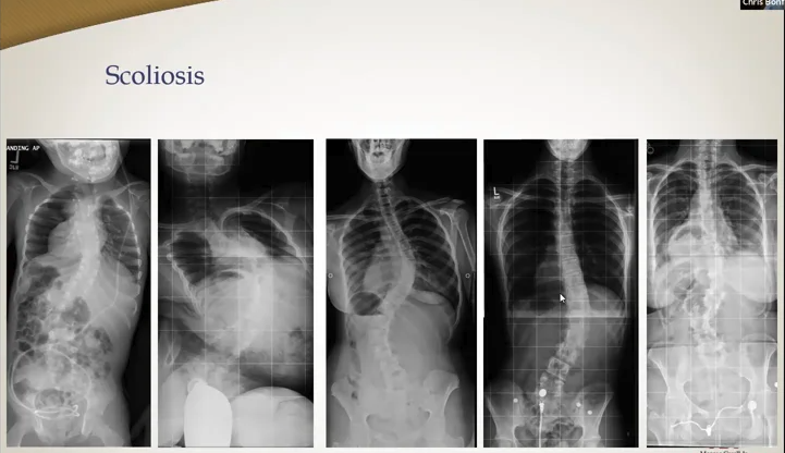 Scoliosis w/ VUMC Neurosurgeon Dr. Chris Bonfield